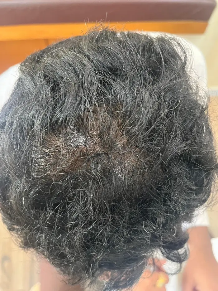 Male Pattern Baldness After
